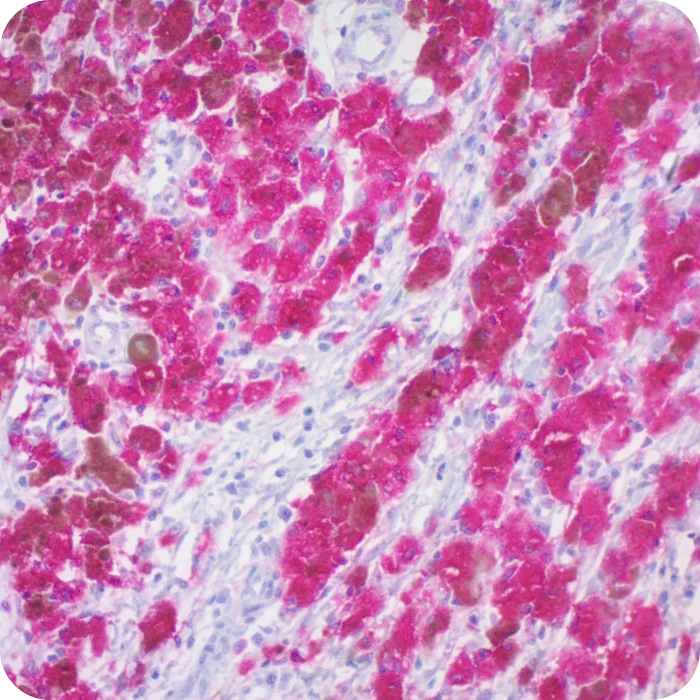A00116-Human-Melanoma-20X-slide-1