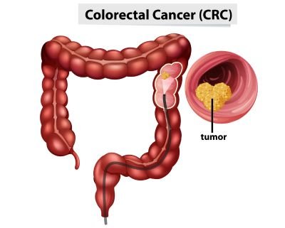 Antibody Tissue For Colon Cancer